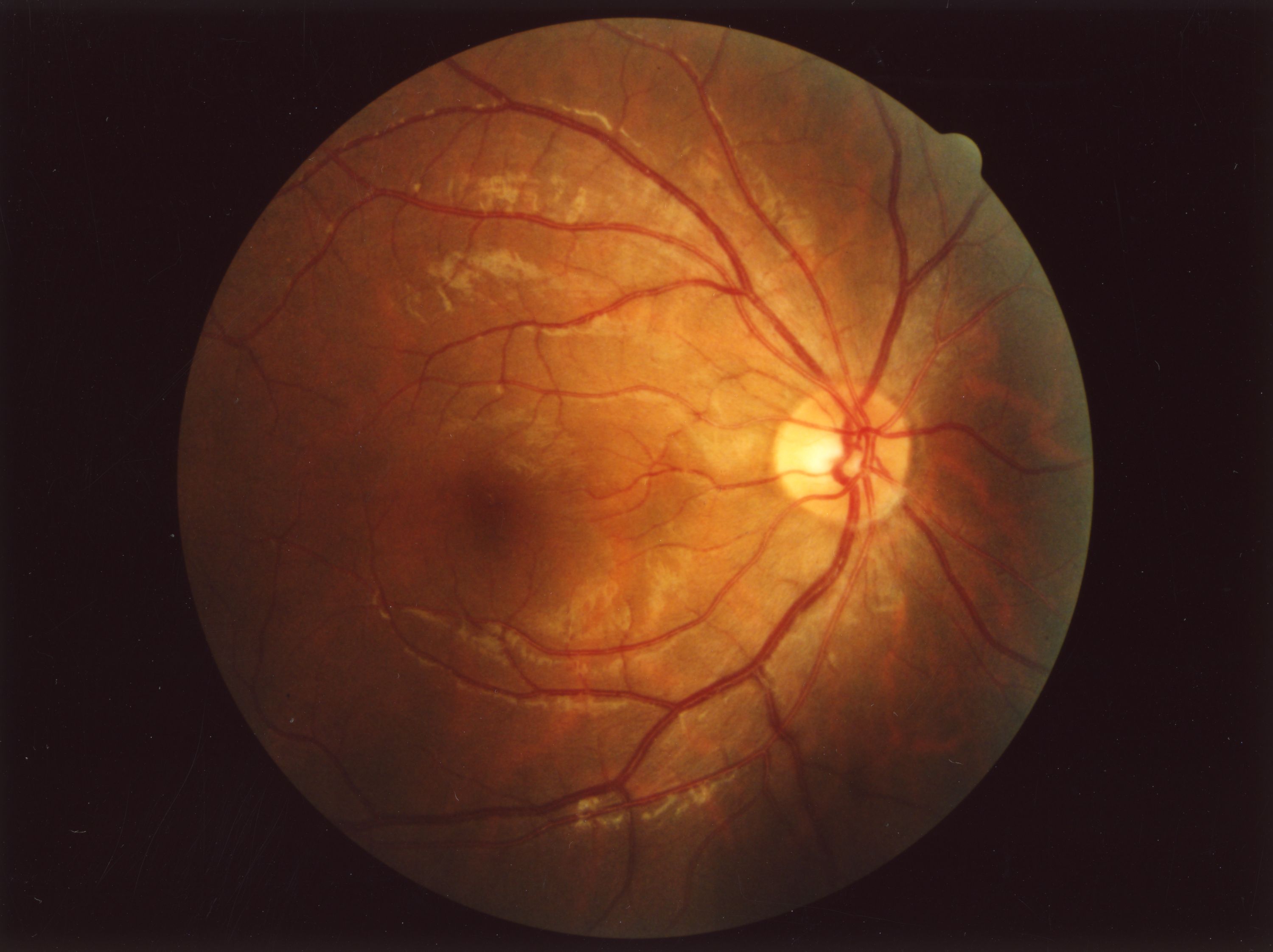 Retinal Sample